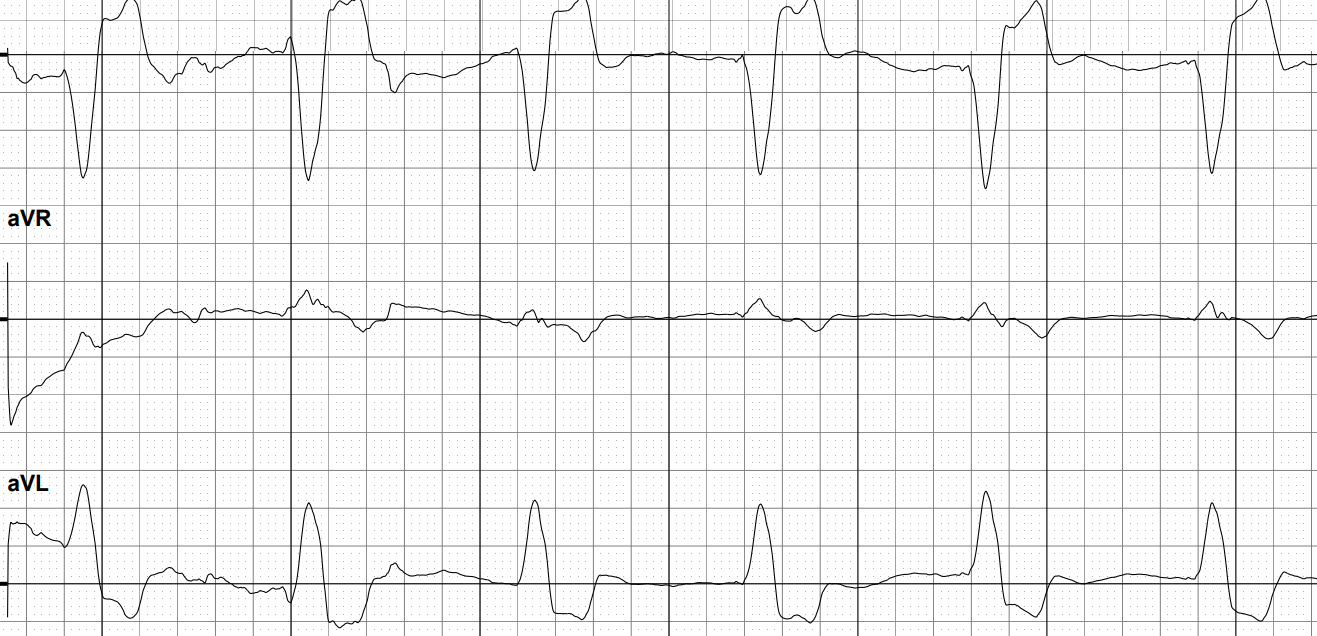 1_29_25_ecg 3 leads lead 2 lead avr and lead avl.png